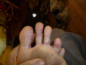 Rotten feet